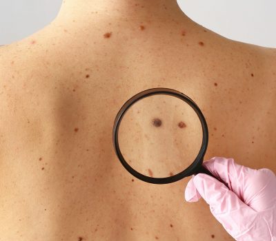A melanóma tünetei, rizikófaktorai és szűrési lehetőségei