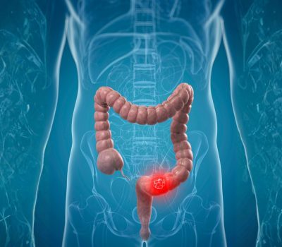 A vastagbélrák tünetei: ezekre érdemes figyelni