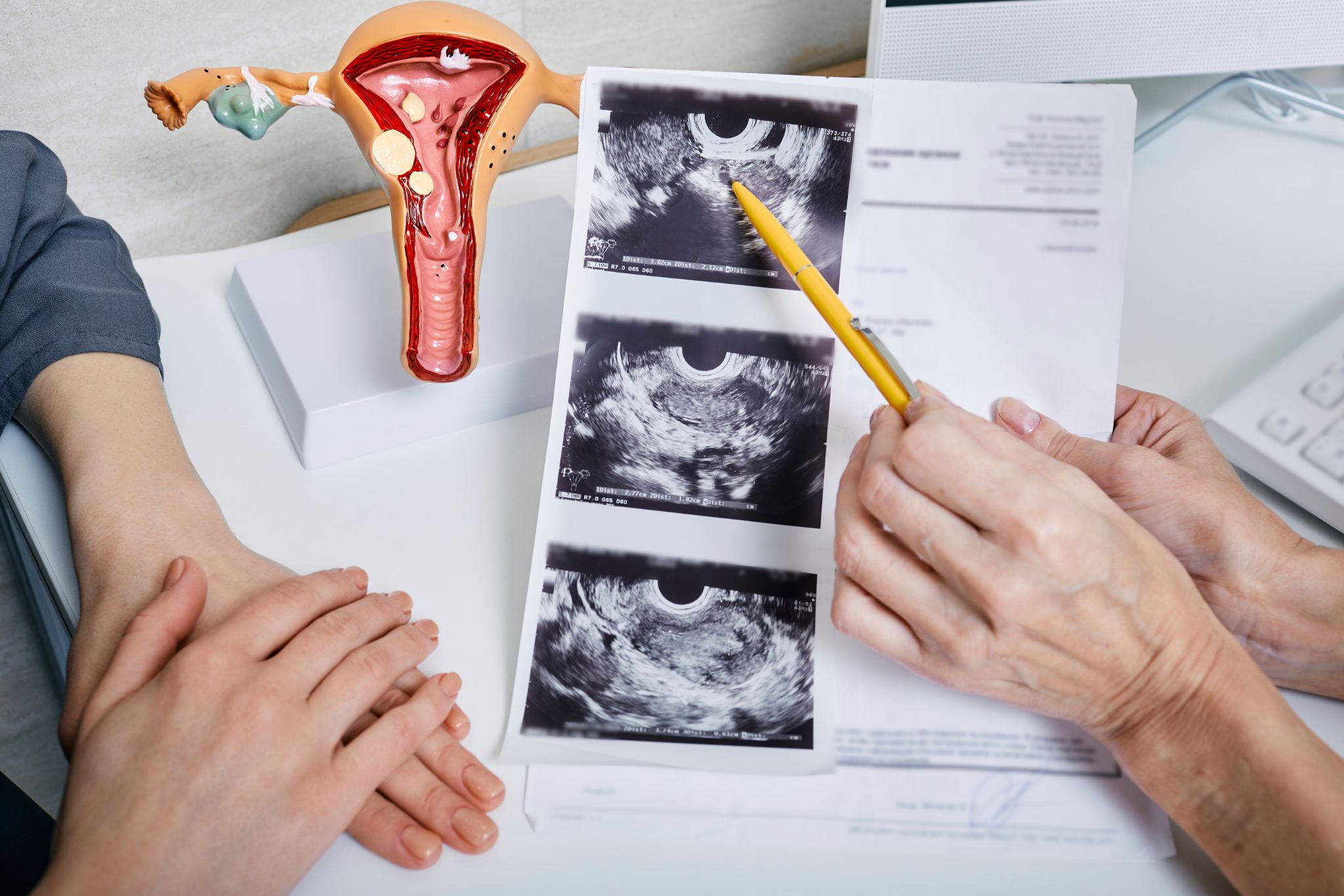 Petefészekrák kezelése és tünetei: miért hívják csendes gyilkosnak? Miért derül ki későn a petefészekrák?