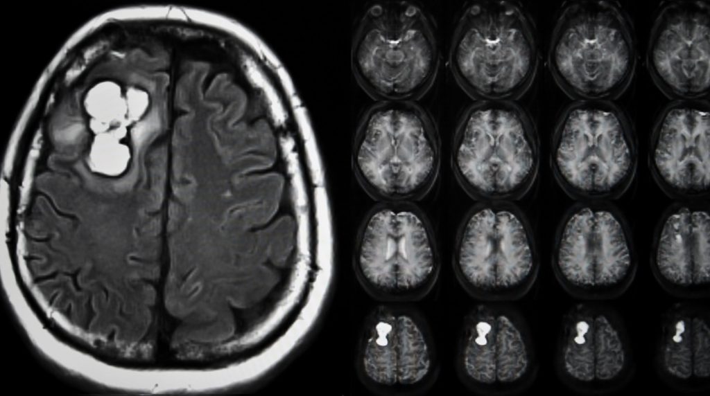 Agydaganatok kezelése és tünetei a glioblastomától a precíziós terápiákig Agytumor képe az MRI-n